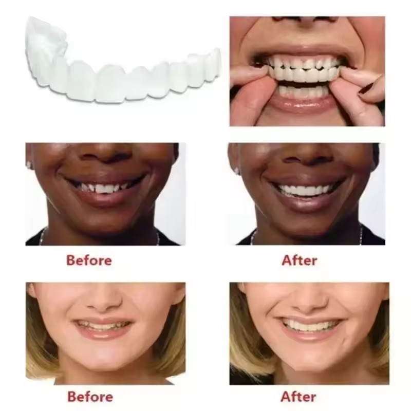 Виниры для отбеливания зубов,  – обзор и цена Teeth Whitening Kit