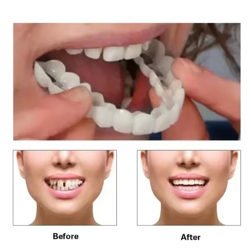 Виниры для отбеливания зубов,  – обзор и цена Teeth Whitening Kit